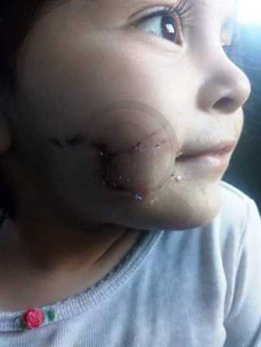 A la pequeña Victoria la atacaron dos Pitbull en Puebla; necesita ayuda para sus medicamentos 9 medicamentos2