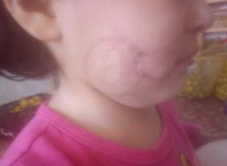 A la pequeña Victoria la atacaron dos Pitbull en Puebla; necesita ayuda para sus medicamentos 10 medicamentos3