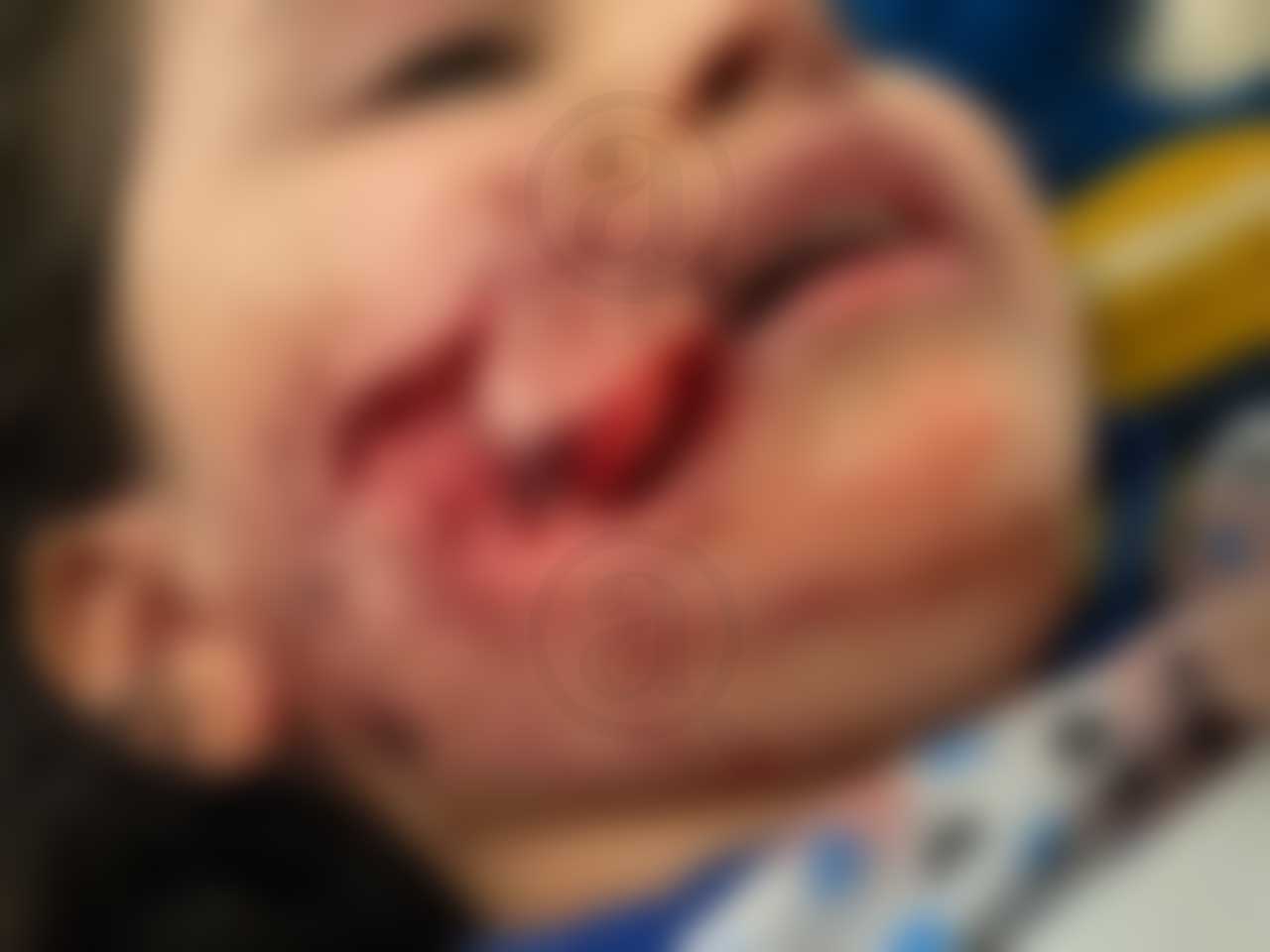 A la pequeña Victoria la atacaron dos Pitbull en Puebla; necesita ayuda para sus medicamentos 11 medicamentos4