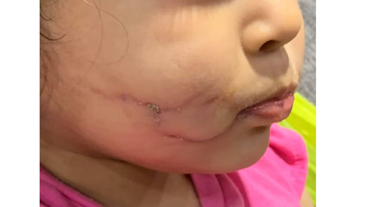 Pitbulls le desfiguran la cara a niña en Puebla; dueño amenaza de muerte a los padres si denuncian 1 victoria