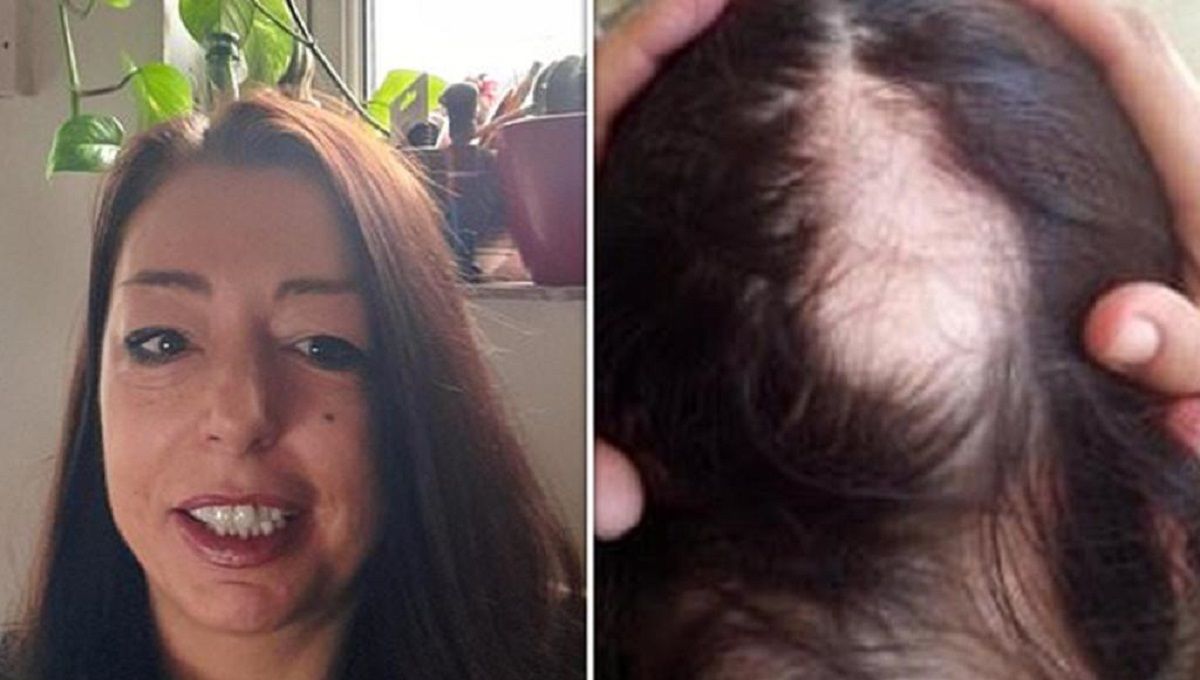 Descubre que tenía COVID-19 cuando empezó a perder el cabello 2 cabello