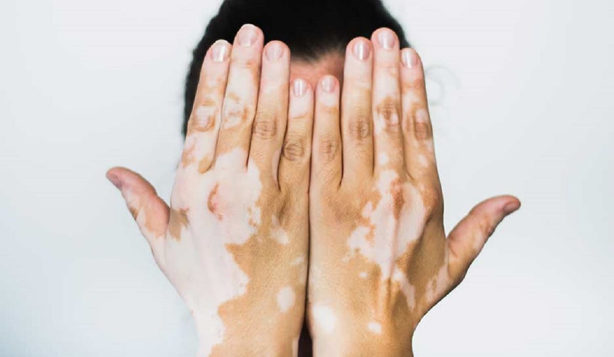 vitiligo 1