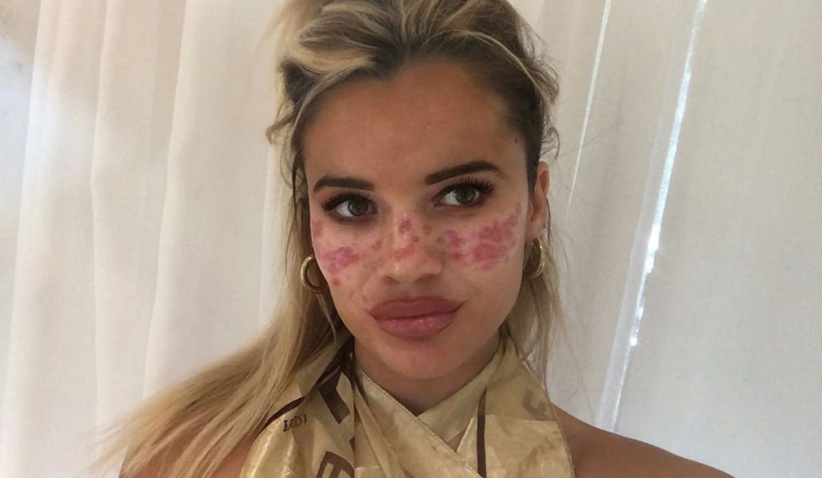 TikToker se quema el rostro al intentar hacer un video viral 2 Tilly Whitfield tik tok 1