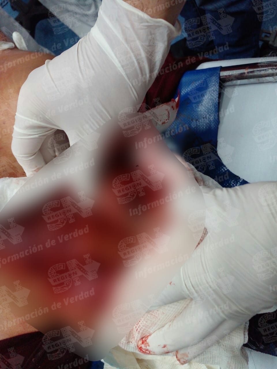 Intenta asaltar una casa y le sacan un ojo con su propio cuchillo en Huauchinango 4 pablo