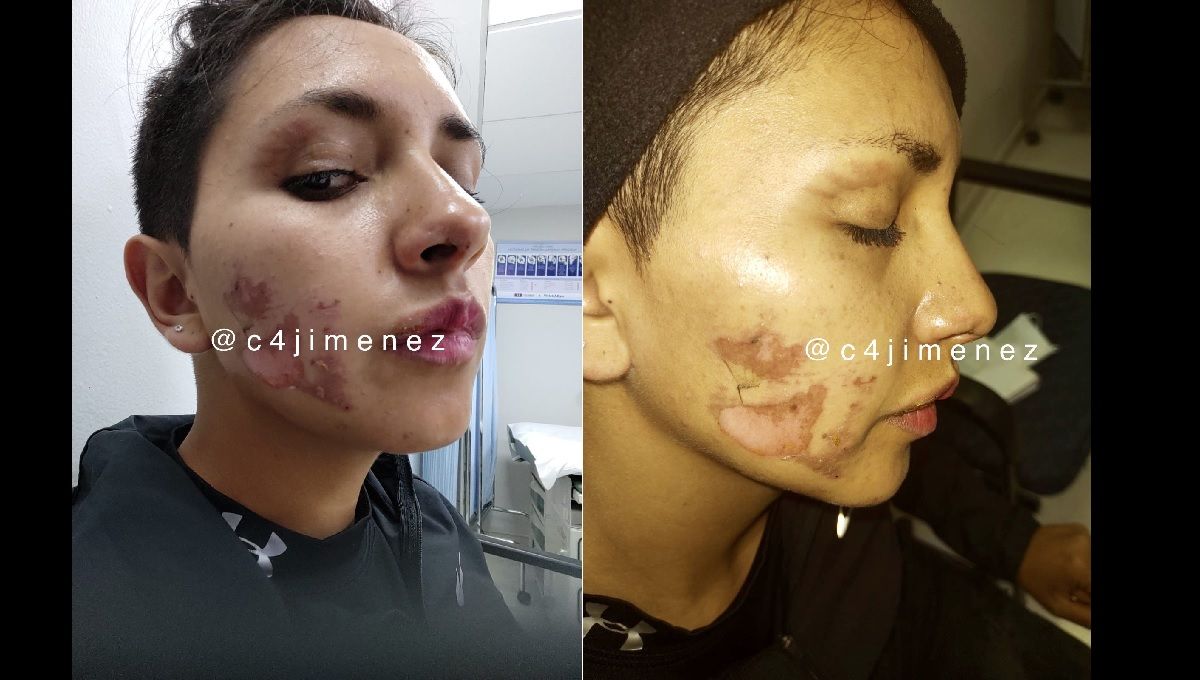Policía resulta con quemaduras en el rostro tras haber sido agredida por manifestantes en la marcha del 2 de octubre 3 bomba molotov