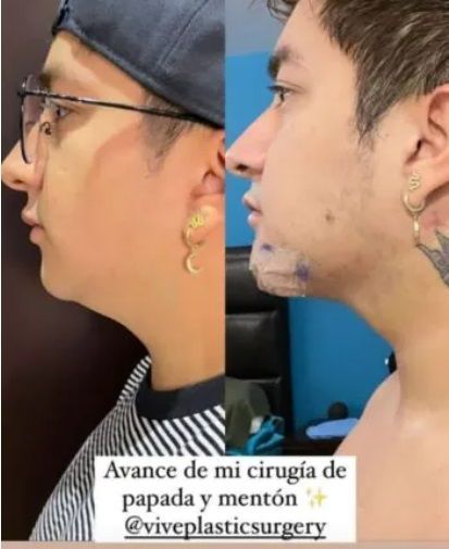 FOTO: El youtuber Mario Aguilar se somete a una cirugía plástica y así luce ahora 4 Mario Aguilar
