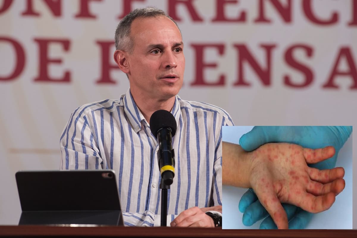 gatel confirma caso de viruela del simio 1