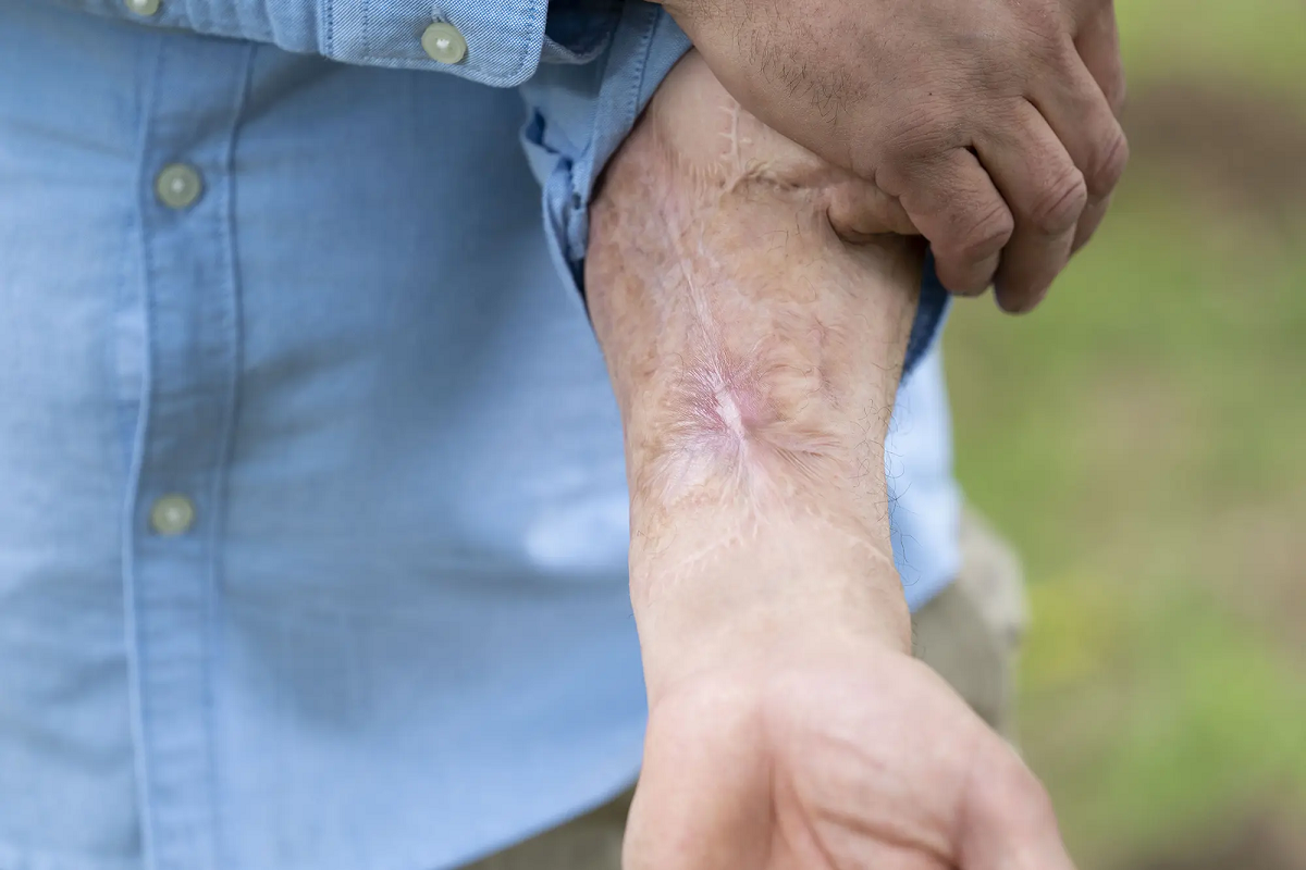 Malcolm MacDonald, el hombre que vivió 8 años con el pene injertado en el brazo 3 pene injerto