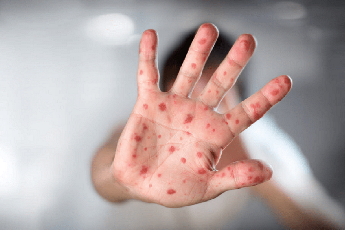 Descarta Salud Puebla casos de viruela del mono 2 viruela de monoo