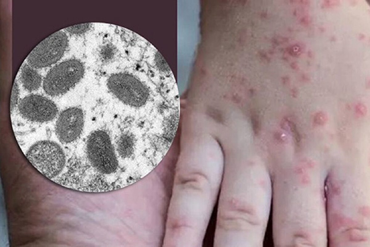 Estas son algunas recomendaciones para protegerse de la viruela del mono 2 virus viruela mono