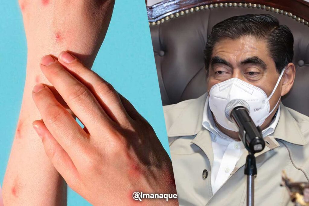 puebla casos viruela simica confirmados