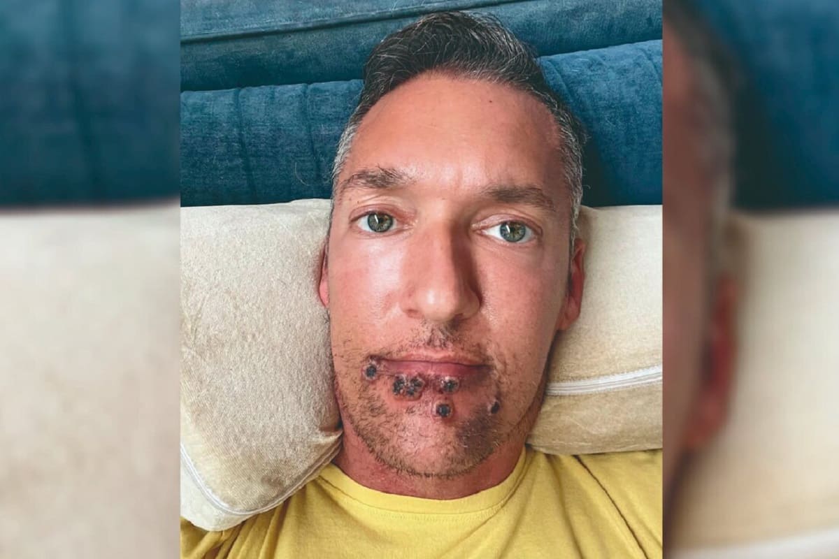 Actor porno narra su experiencia tras contagiarse de viruela del mono 4 viruela del mono 1 1