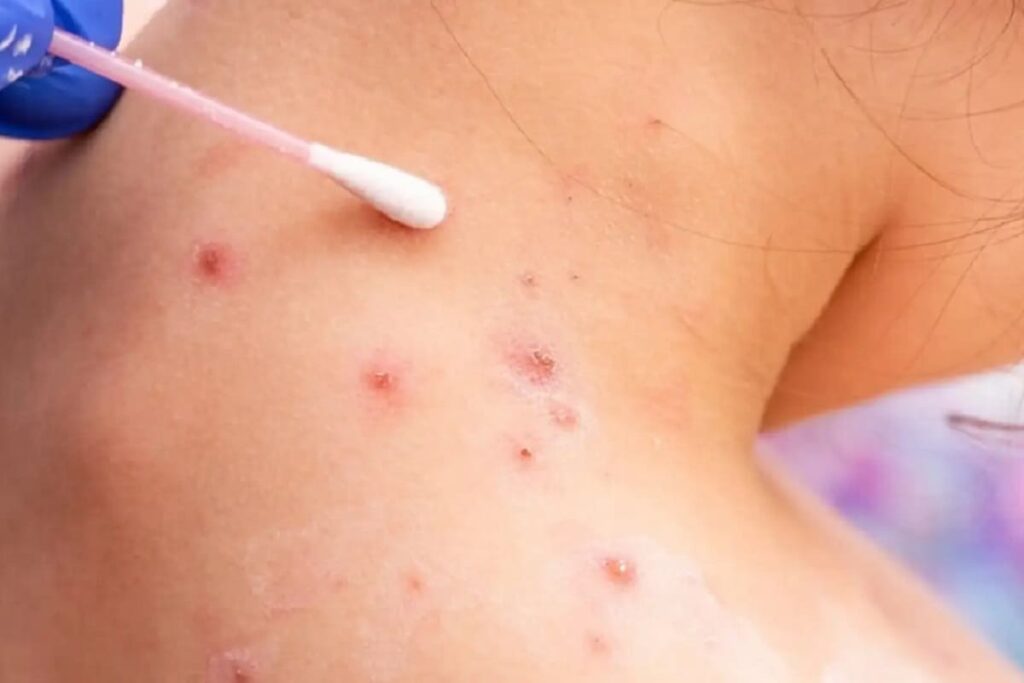 Muere Paul Alexander, hombre que vivió más de 70 años con “pulmón de acero” por polio 6 viruela del mono 1