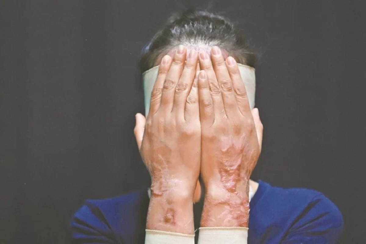 Diputada del PAN propone castigar hasta con 30 años de cárcel ataques con ácido 2 ataque acido