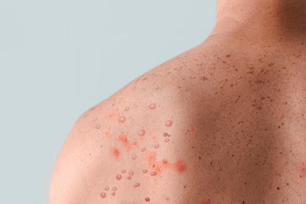 Reporta Puebla 20 casos de viruela del mono: Salud 2 viruela mono piel