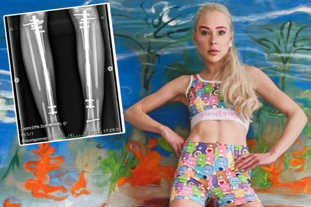 Modelo alemana Theresia Fischer se sometió a cirugías para alargar sus piernas