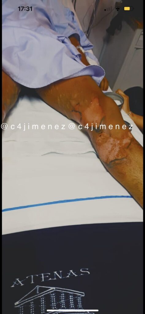 rocían gasolina y prenden fuego a cristian en Texcoco