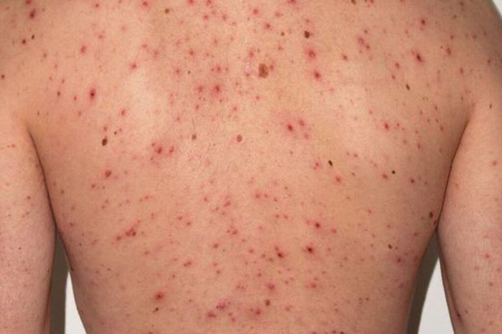 casos sarampión aumentan Europa