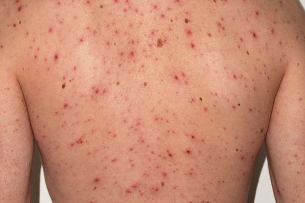 Casos de sarampión en Europa aumentan hasta 42 mil en un año 1 casos sarampión aumentan Europa