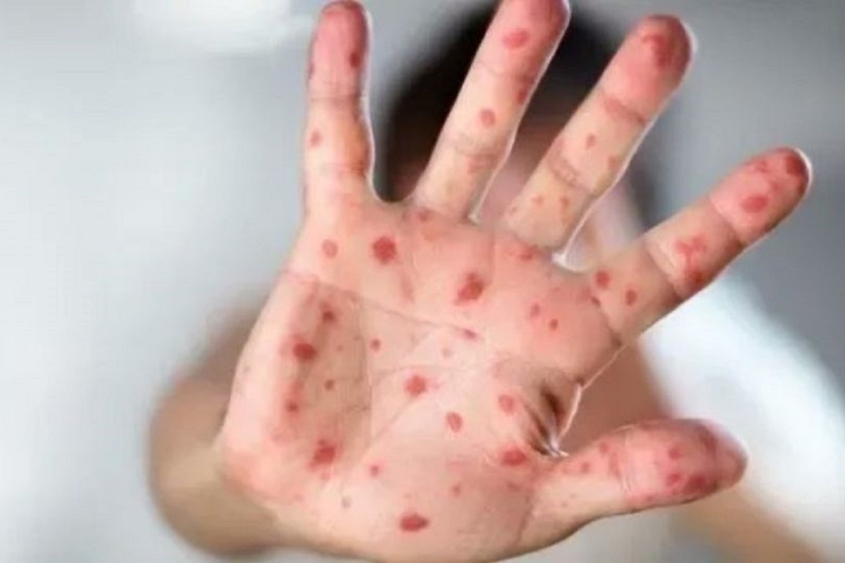 Confirman dos casos de viruela del mono en Puebla 1 Cuántos casos de viruela del mono se han registrado en México