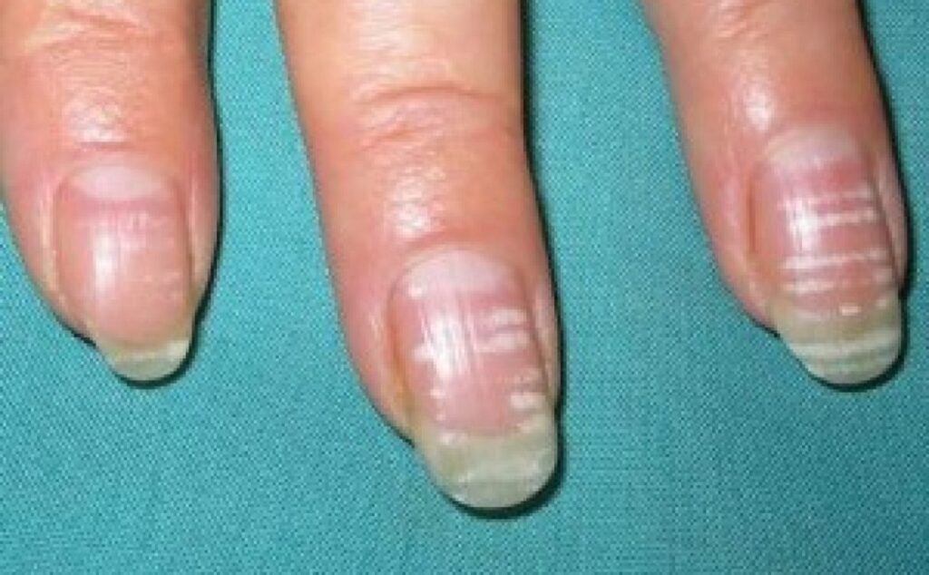 manchas blancas en las uñas