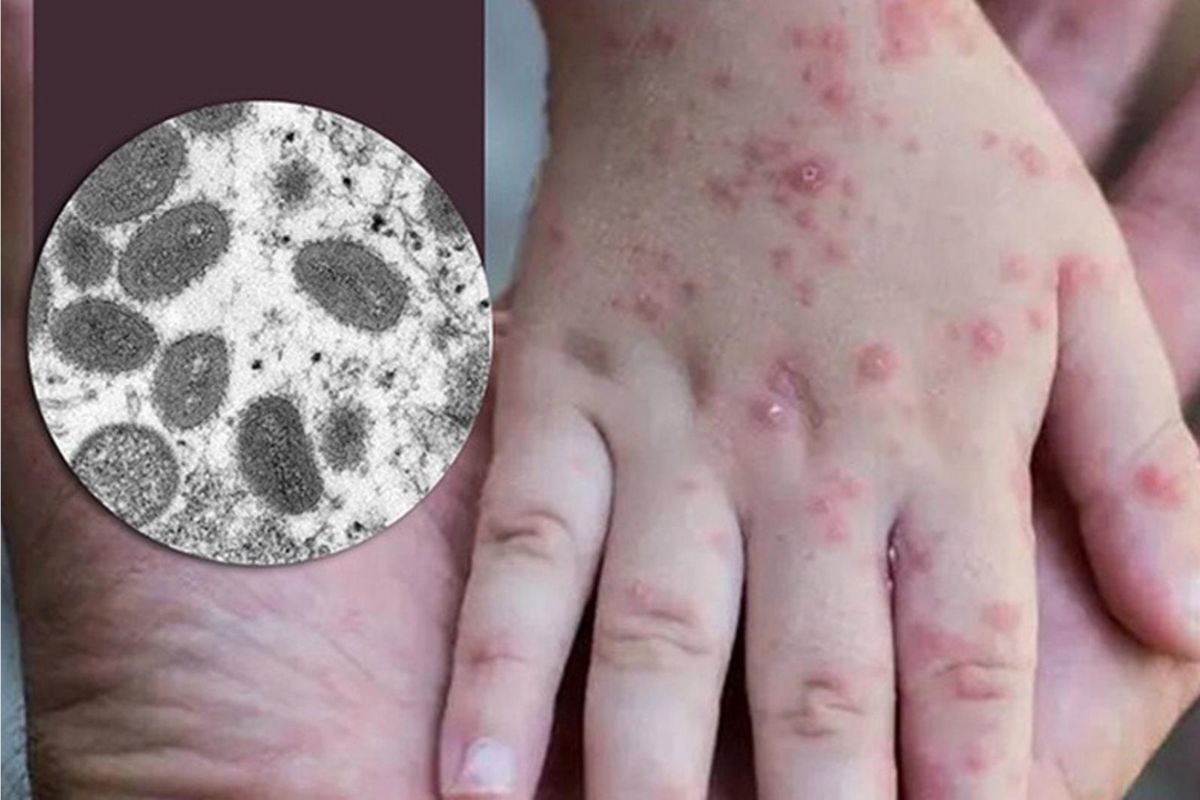 OMS declara viruela del mono como emergencia mundial ¿cuáles son los síntomas del mpox? 1 viruela del mono alerta mundial