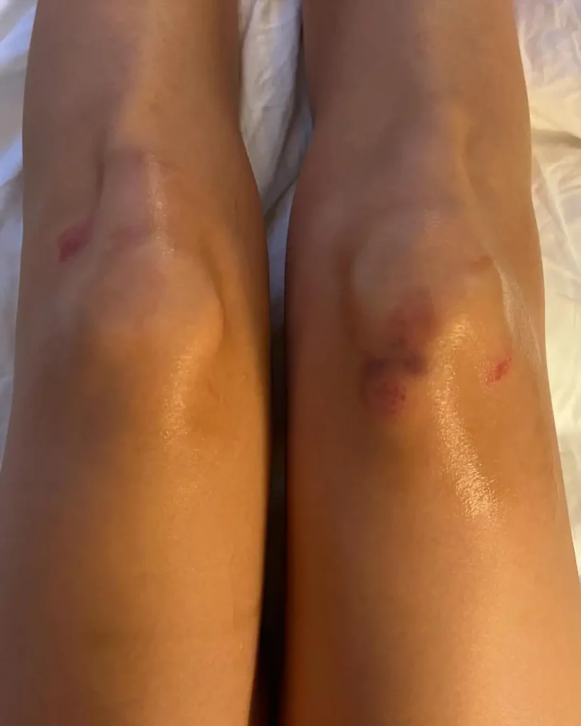 Así quedaron las rodillas de Belinda tras su caída en la Fashion Week 2 Así quedaron las rodillas de Belinda tras su caída en la Fashion Week