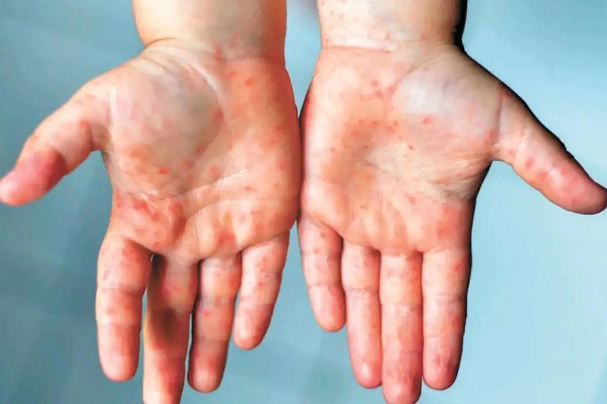 Detectan brote del virus coxsackie en San Martín Texmelucan, Puebla; instalan cerco sanitario 1 coxsackie en San Martín Texmelucan