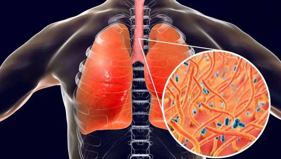 Mueren dos bebés por tos ferina en IMSS La Margarita