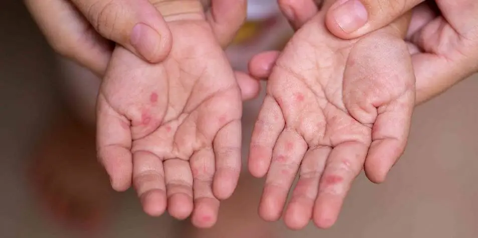 Virus Coxsackie en Puebla: Se confirma brote en primaria de Bosques de San Sebastián