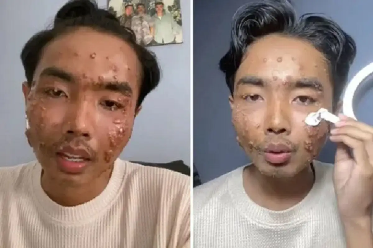 Influencer contrae infección viral tras usar ropa de segunda mano sin lavar