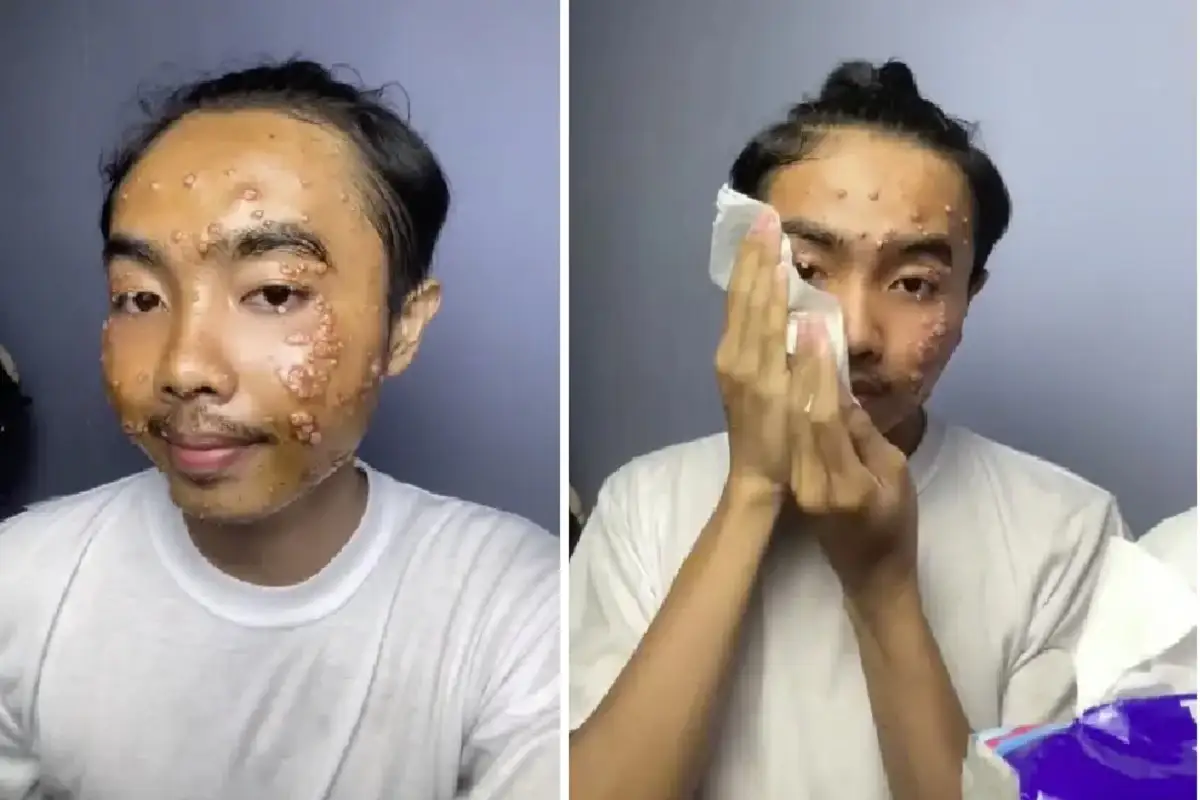 Influencer contrae infección viral tras usar ropa de segunda mano sin lavar