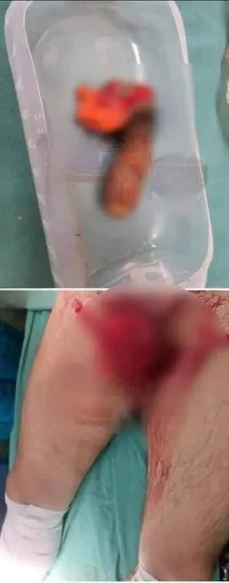 IMÁGENES FUERTES: Mujer le corta el pene a su esposo tras enterarse que abusó de su sobrina 3 Mujer le corta el pene a su esposo tras enterarse que abusó de su sobrina