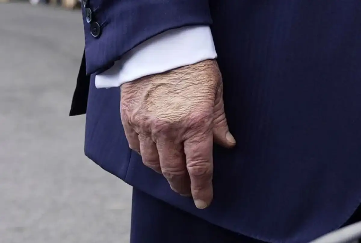 Diagnostican a Donald Trump con insuficiencia venosa crónica