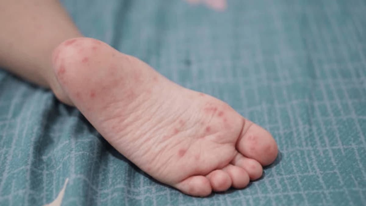 Detectan 419 estudiantes con síntomas del virus Coxsackie en 20 municipios de Puebla 2 Detectan 419 estudiantes con síntomas del virus Coxsackie en 20 municipios de Puebla