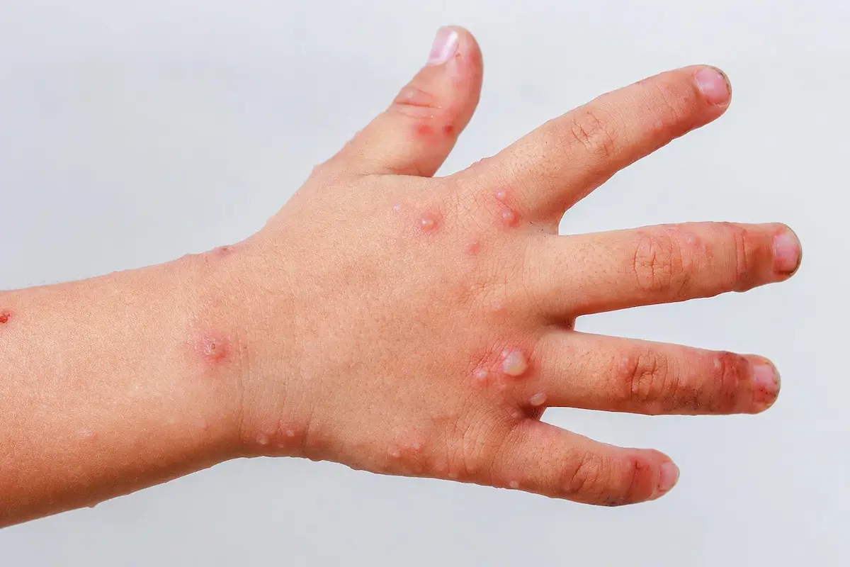Detectan 419 estudiantes con síntomas del virus Coxsackie en 20 municipios de Puebla