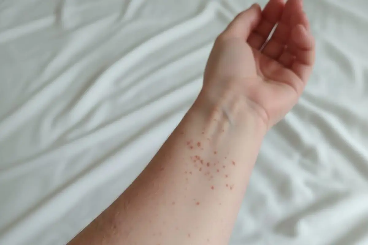 Confirma salud primer caso de sarampión en Puebla