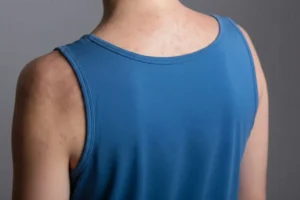 Van 16 casos de sarampión en Puebla en enero 2026