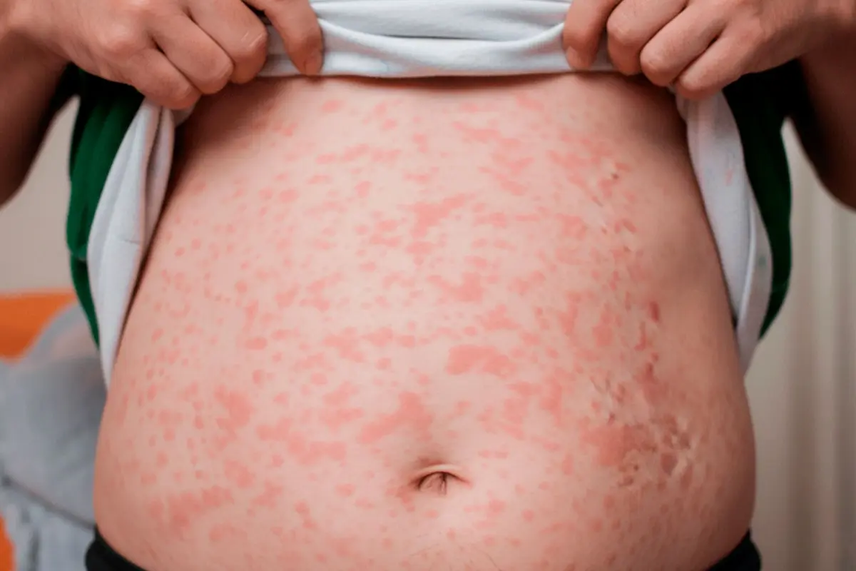 casos de sarampión en Puebla 2026