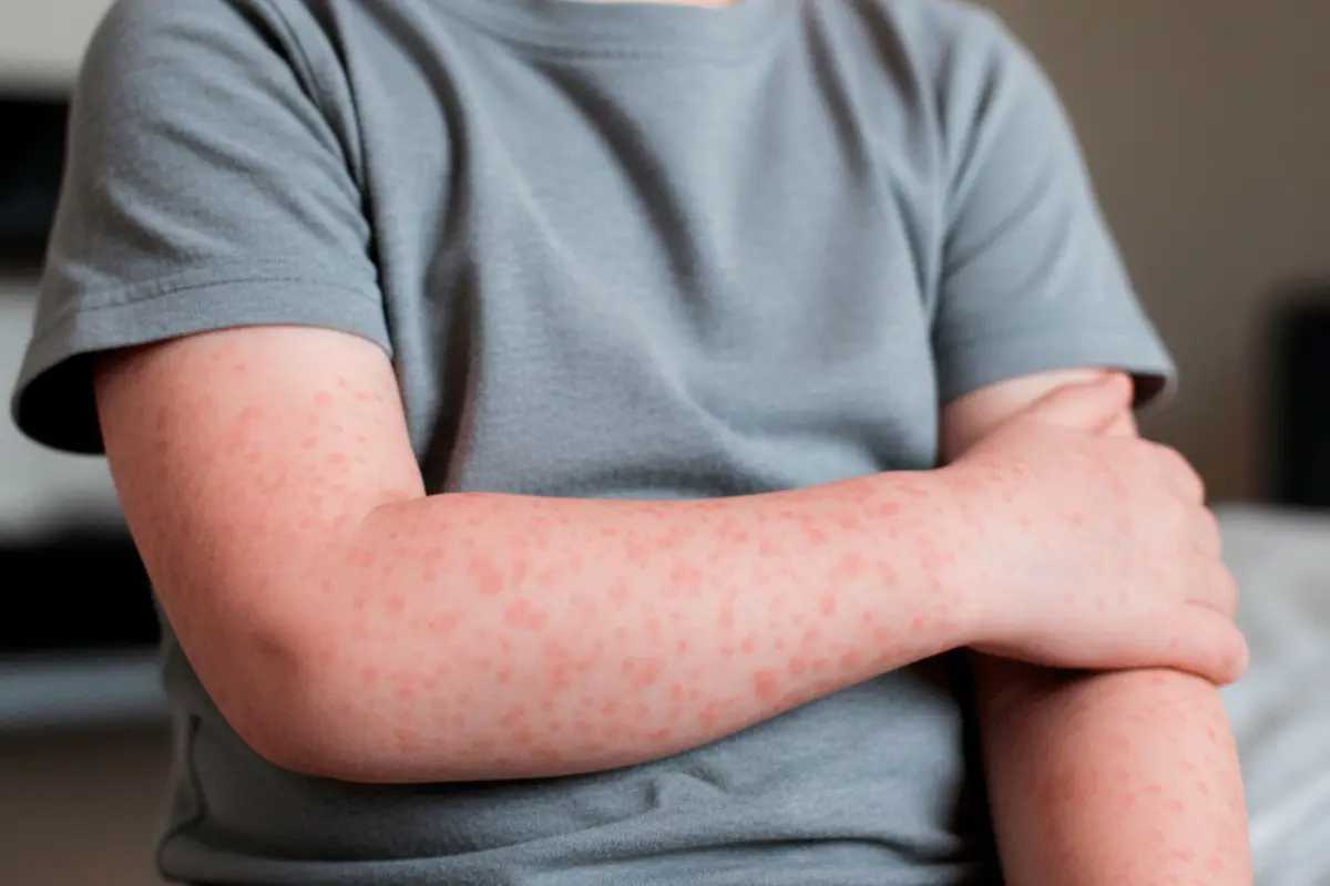 casos de sarampión en Puebla 2026