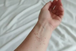 Aumentan a dos el número de casos de sarampión en Puebla