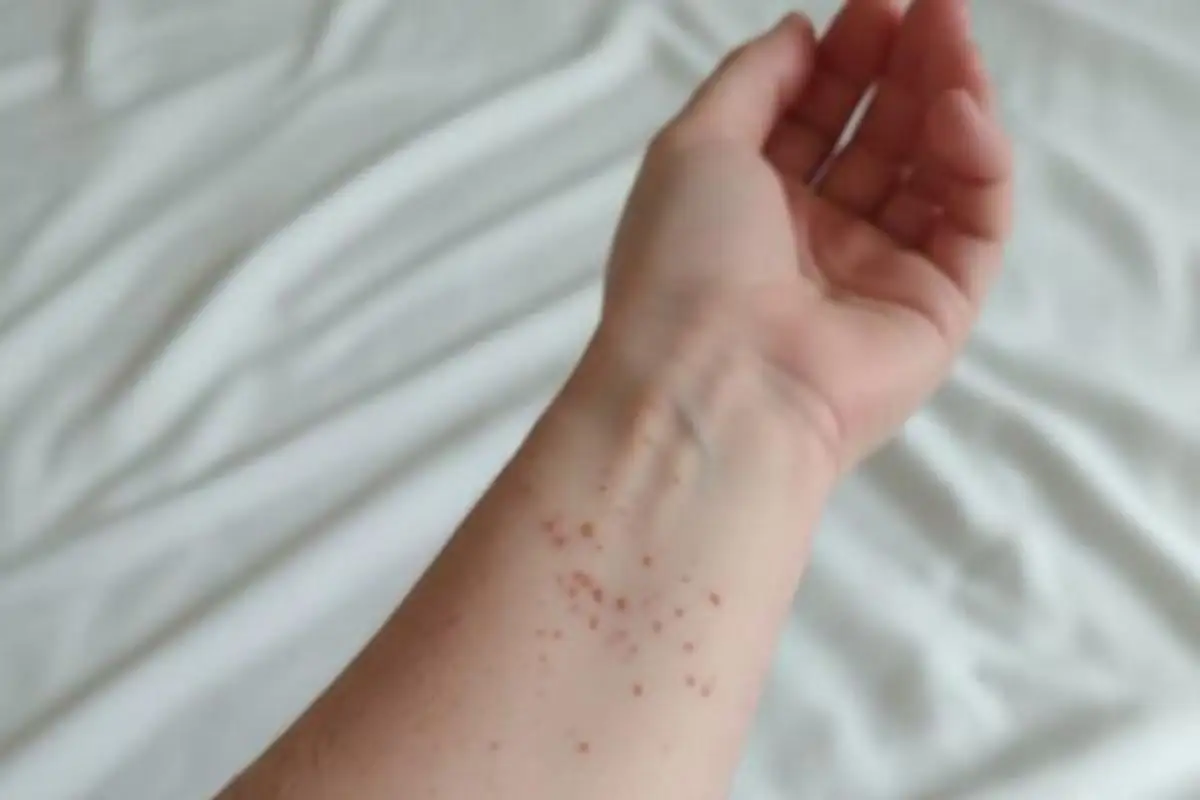 Aumentan a dos el número de casos de sarampión en Puebla