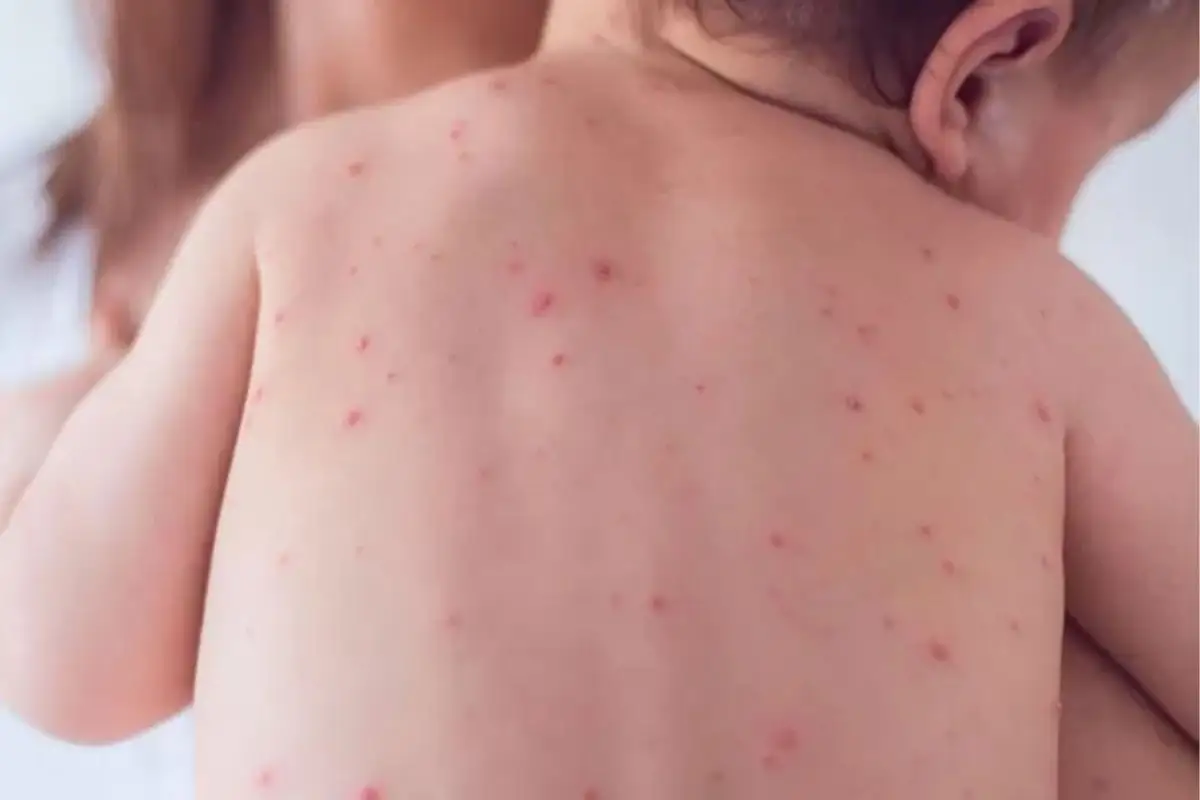 Michoacán registra primera muerte por sarampión en 2026