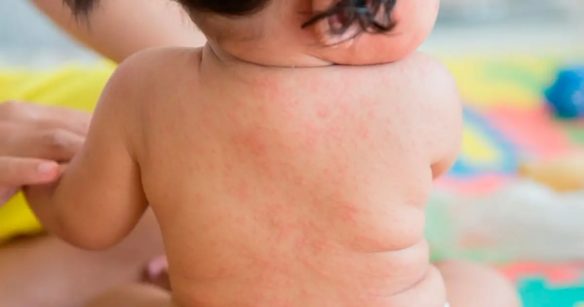 Tlaxcala registra la primera muerte por sarampión en México