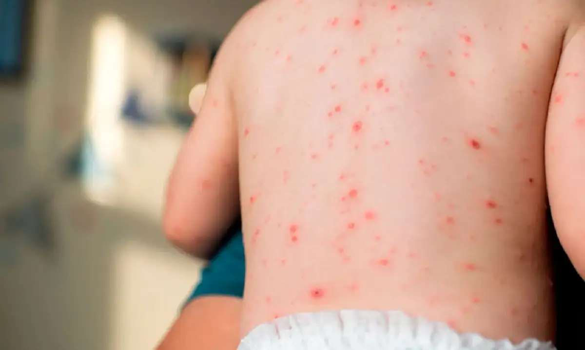 Tlaxcala registra la primera muerte por sarampión en México