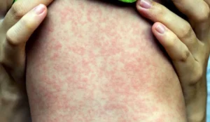 Cómo se contagia el sarampión