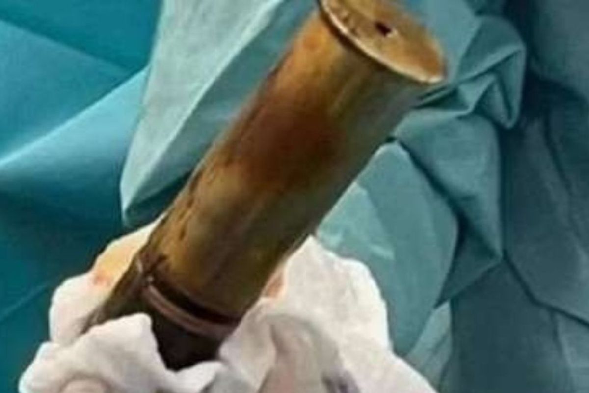 Hombre es hospitalizado tras introducirse por el recto un proyectil explosivo de la Primera Guerra Mundial