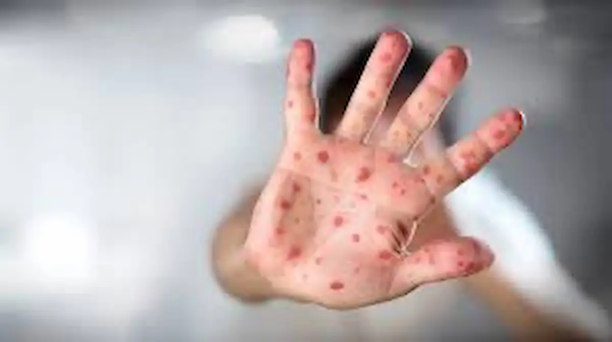 Qué es el sarampión