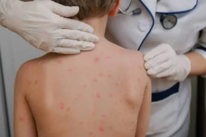 Qué es el sarampión