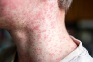 Reportan 10 nuevos casos de sarampión en Puebla